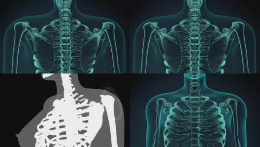 3D插图的肩膀疼痛，医疗概念动画。高清在线视频素材下载