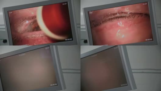 医生屏幕上的眼科手术。白内障摘除手术。近距离高清在线视频素材下载