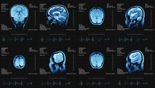 两个动画图像的mri大脑扫描在一个医疗显示心脏bps和其他数据高清在线视频素材下载