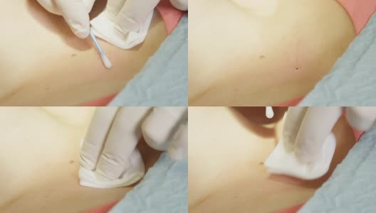 皮肤外科手术后的小伤口消毒高清在线视频素材下载
