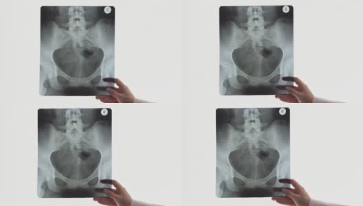 女医生手持骨盆骨x光片。放射科医师在光幕或负镜背景下检查扫描。逐渐关注高清在线视频素材下载
