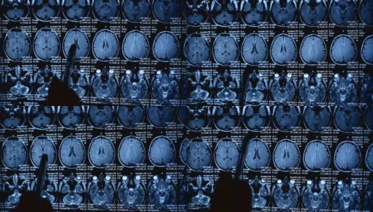 医生分析MRI CT扫描。他发现了一个问题。高清在线视频素材下载