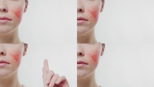 一个女人的脸与红肿的脸颊特写。女性的手按下触摸屏上的虚拟按钮。关闭了。白色背景。酒渣鼻与皮肤病的概念高清在线视频素材下载