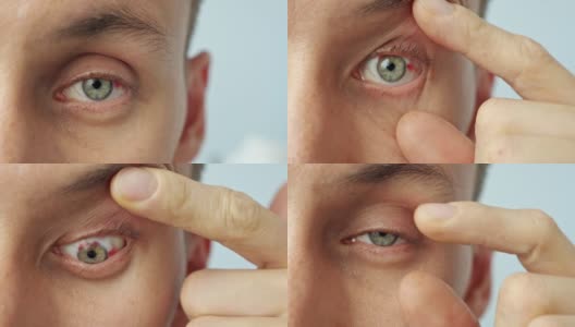 一个男人疼痛的眼睛，张开手指高清在线视频素材下载
