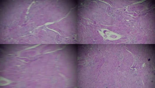 子宫内膜癌生物标本在不同范围的显微镜放大高清在线视频素材下载