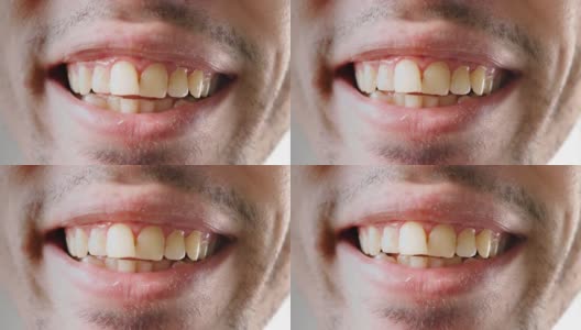 特写镜头。男人微笑着露出他那弯曲的黄牙。牙科保健概念高清在线视频素材下载