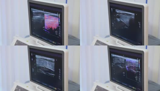 医学。监视器上的超声波图像。高清在线视频素材下载