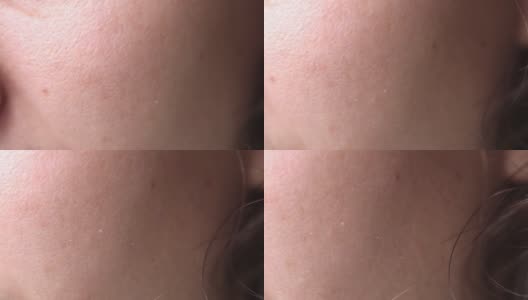 女性皮肤过敏问题紧锁。面部干燥，毛孔鳞状，发红。高清在线视频素材下载