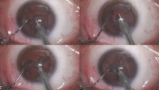 白内障眼科手术高清在线视频素材下载