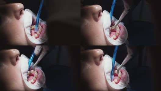 年轻女牙医在正畸医师接待处更换牙套抛光胶粘合高清在线视频素材下载
