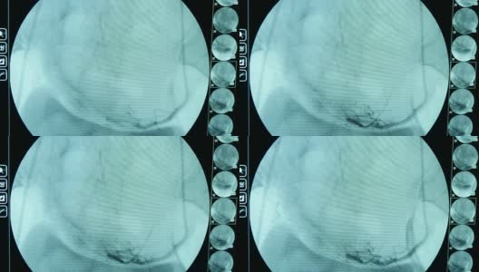 未来的x射线扫描仪，用于乳房x光检查，有一个大的蓝色屏幕高清在线视频素材下载