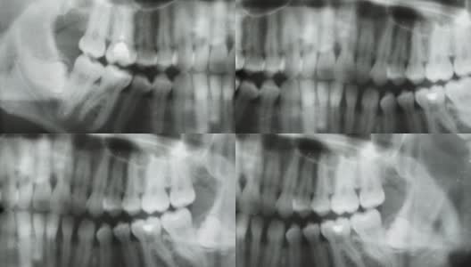 相机沿牙科全景x光移动。水平追踪上下颌牙齿。CAT扫描的特写高清在线视频素材下载