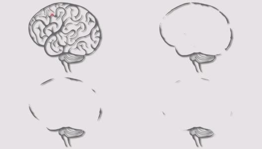 大脑的破坏,动画。脑部疾病的焦点。脑损伤或紊乱的概念。高清在线视频素材下载