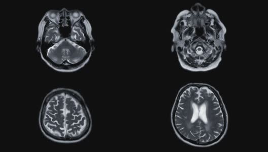 MRI脑或核磁共振成像(MRI)的脑轴t2诊断中风疾病。高清在线视频素材下载