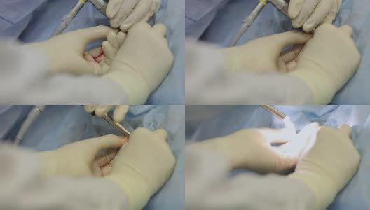 特写是外科医生用碎石术从病人的肾脏中取出结石。高清在线视频素材下载