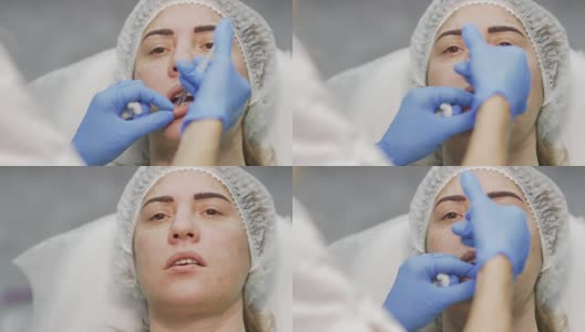 医生增加女性的嘴唇注射肉毒杆菌毒素高清在线视频素材下载