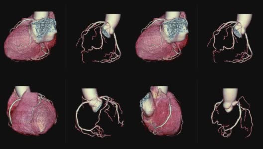 CTA冠状动脉三维渲染图像对比心脏三维和冠状动脉三维在屏幕上旋转，用于血管冠状动脉狭窄的诊断。高清在线视频素材下载