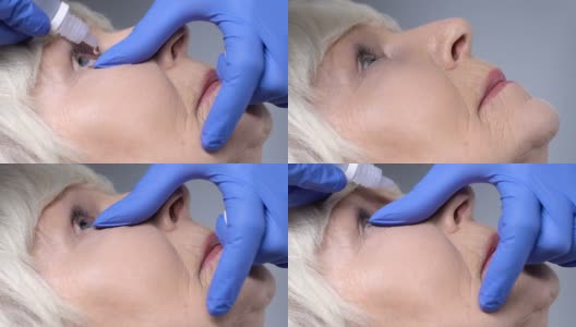 在手术前，眼科医生将药物滴入成熟女性的眼睛高清在线视频素材下载