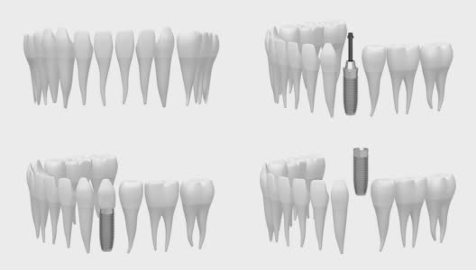 3D种植牙/种植牙高清在线视频素材下载