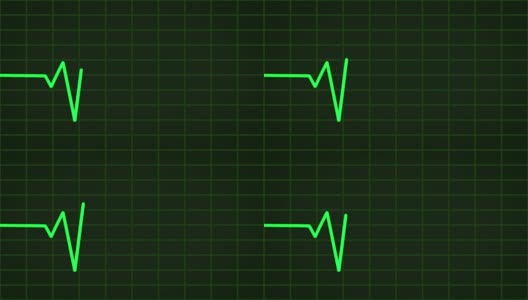 心电图(EKG或ECG)环绿色高清在线视频素材下载