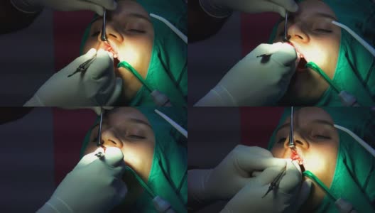 口腔外科手术，cist根尖切除术，暗室手术高清在线视频素材下载