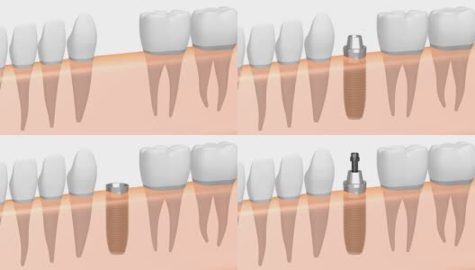 3D种植牙/种植牙高清在线视频素材下载