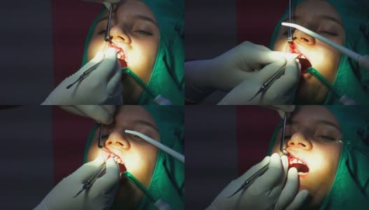 口腔牙科手术切缝、齿龈根尖切除囊肿清除高清在线视频素材下载