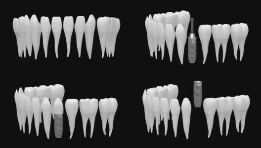 3D种植牙/种植牙高清在线视频素材下载