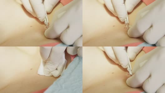 闭合:局部麻醉下用手术刀摘除胎记高清在线视频素材下载