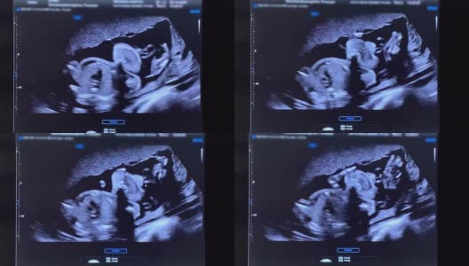 孕妇进行超声波检查。高清在线视频素材下载