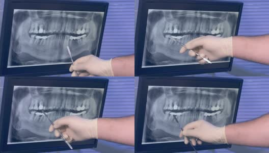 牙齿的x光全景照片和牙医的手与工具移动屏幕高清在线视频素材下载