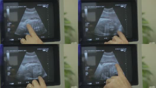 在超声波显示器上，人类胚胎正在轻微地移动他的头部高清在线视频素材下载