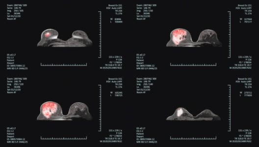 放射学检查乳腺癌检测高清在线视频素材下载