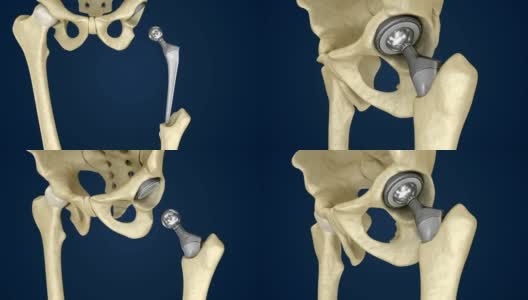 髋关节置换植入物安装在骨盆骨。医学精准3D动画高清在线视频素材下载