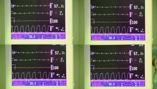 手术室和急诊室的心率监视器显示心跳高清在线视频素材下载