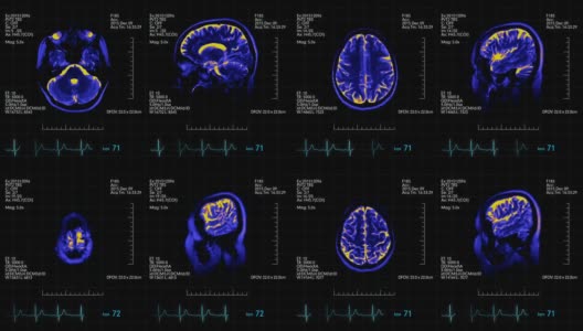 MRI大脑扫描未来显示蓝色和橙色与心率监视器高清在线视频素材下载