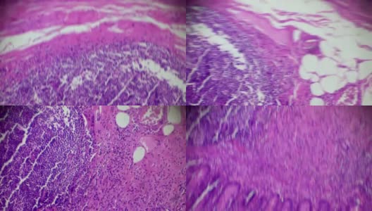 慢性阑尾炎光镜下病理分析高清在线视频素材下载