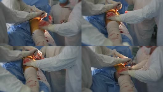 整形外科医生在一个房间里把一根大金属棒插入一个人的臀部关节高清在线视频素材下载