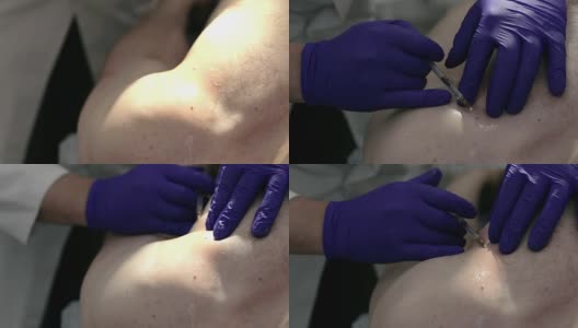 手术切除胎记前，医生在胎记周围注射局麻药高清在线视频素材下载