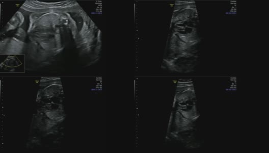精彩的心脏跳动机制近距离-超声扫描妊娠3d和4d超声检查妊娠胎儿人类胚胎检查胎儿超声26周女婴妊娠中期高清在线视频素材下载