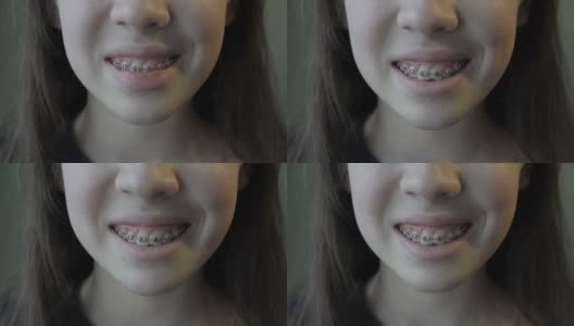 一个戴着牙套的孩子的嘴的特写。一个十几岁的女孩微笑着，嘴里露出金属牙套。4 k。高清在线视频素材下载