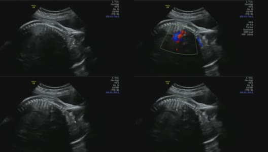 令人难以置信的颜色调整心率跳动插图-超声扫描妊娠3d和4d超声检查妊娠胎儿人类胚胎检查胎儿超声检查26周中期妊娠女婴高清在线视频素材下载
