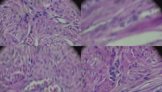 子宫内膜癌生物标本在不同范围的显微镜放大高清在线视频素材下载