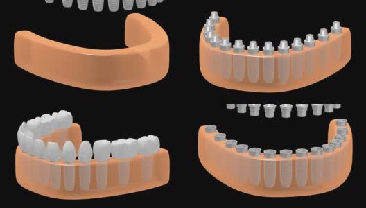 3D牙科种植/牙齿种植高清在线视频素材下载
