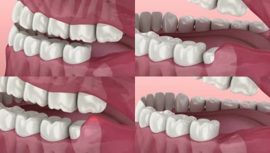 智齿的问题。医学上准确的牙齿3D动画高清在线视频素材下载