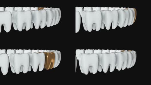 金牙排成一排洁白的牙齿。3 d渲染。牙科，挤出人群，经营理念高清在线视频素材下载