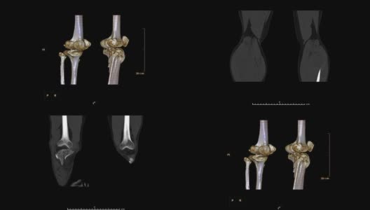 CT扫描双膝三维渲染图像在屏幕上旋转。高清在线视频素材下载