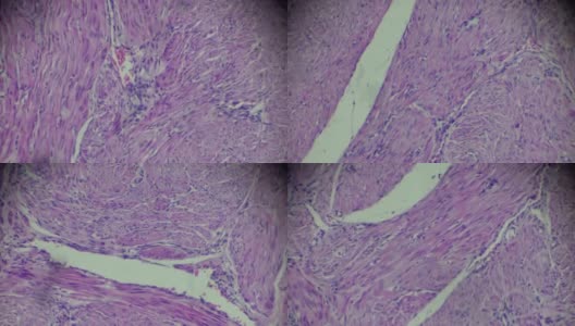 子宫内膜癌生物标本在不同范围的显微镜放大高清在线视频素材下载