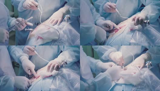 Surgical operation of the abdomen. Suturing高清在线视频素材下载