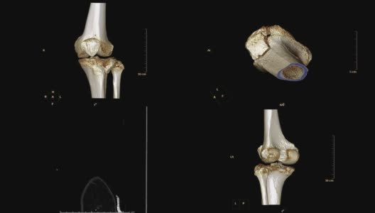右膝CT扫描三维渲染图像。高清在线视频素材下载
